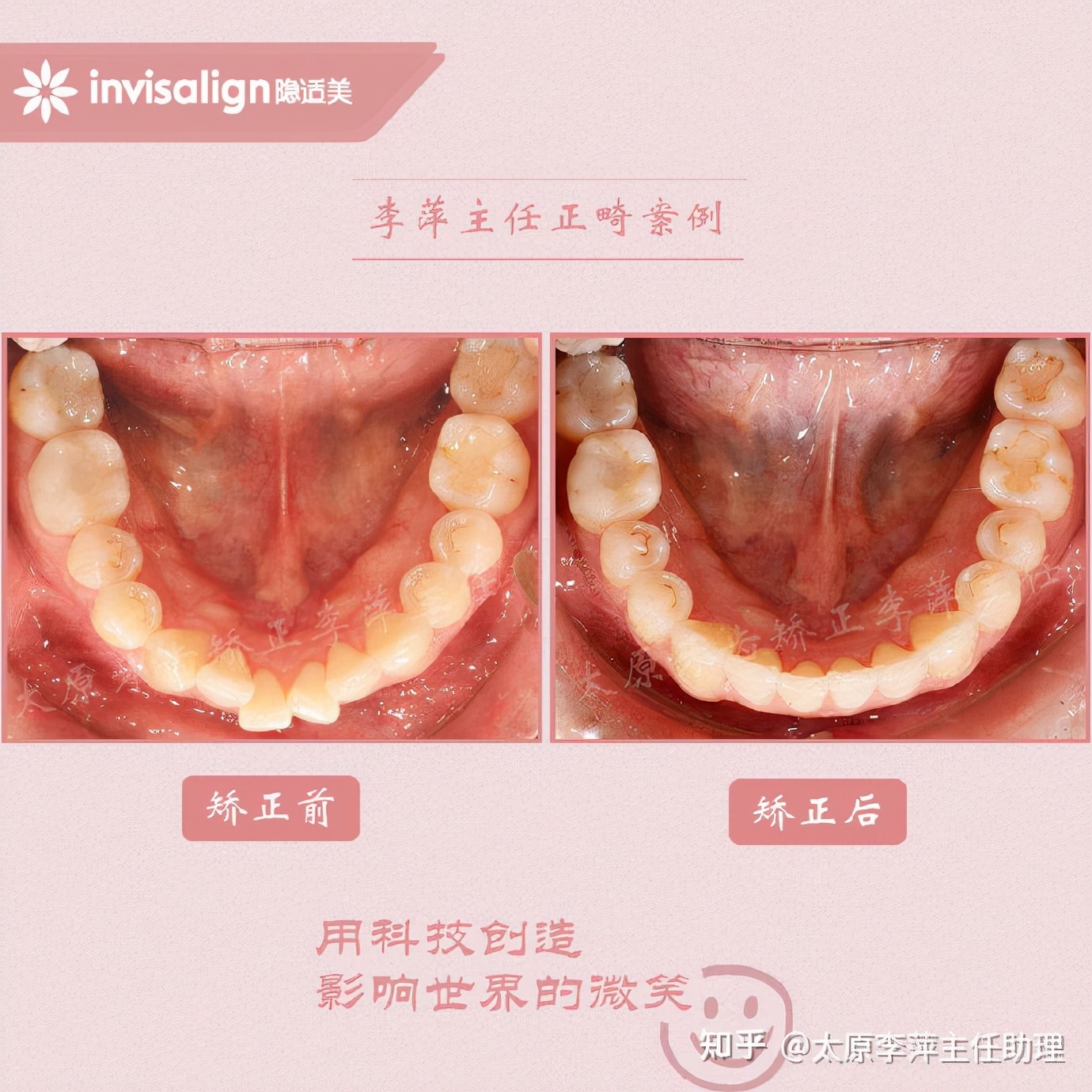 太原牙齿矫正靠谱吗,太原成人隐形牙套牙齿不齐