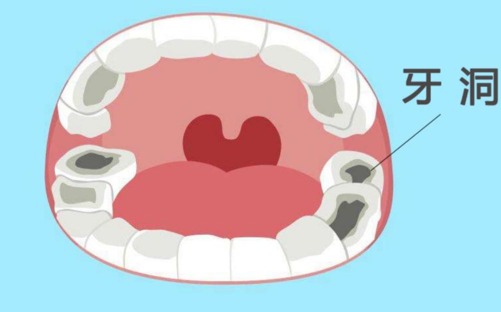 蛀牙是怎么形成的真的有虫吗,蛀牙真的是因为虫子吗