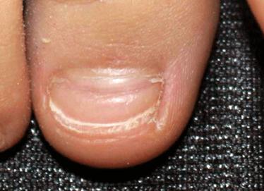 宝宝指甲出现白点,孩子指甲上有白色斑点倪海厦