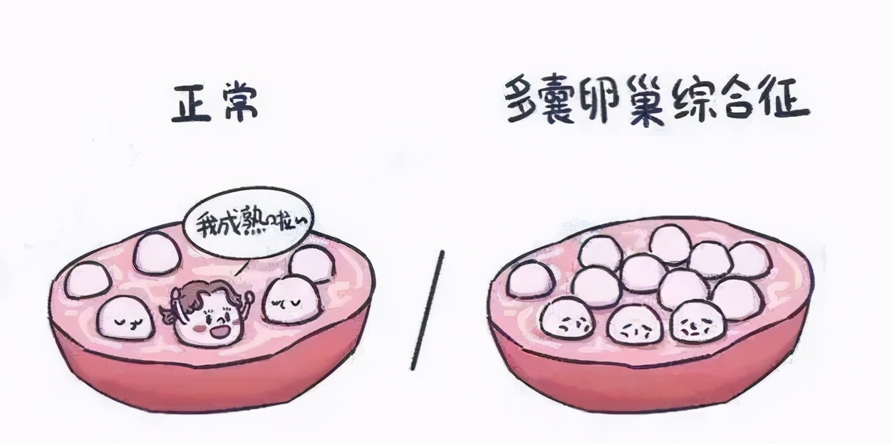 多囊两次促排失败了怎么办,多囊多次促排失败怎么办