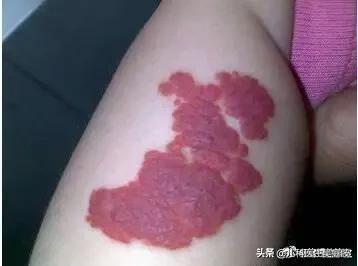 宝宝得了血管瘤要紧不要紧,宝宝身上患血管瘤