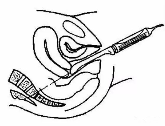 盆底超声可检查什么疾病,哪些疾病需要做妇科检查