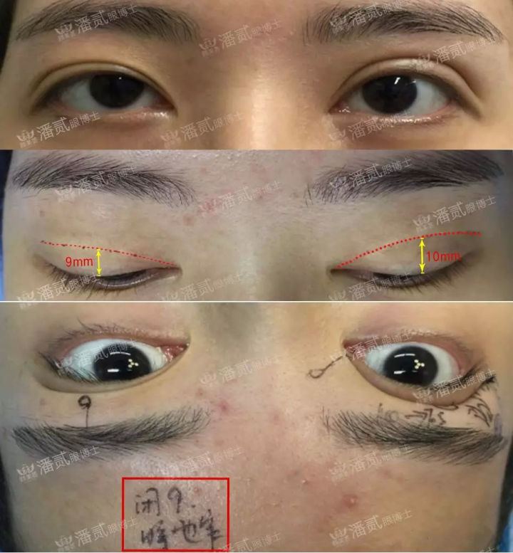 双眼皮手术科普：割双眼皮七大常见误区，您中招了几个？