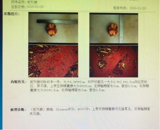 前列腺癌转移骨髓瘤治愈经验,前列腺癌骨转移抗癌成功案例