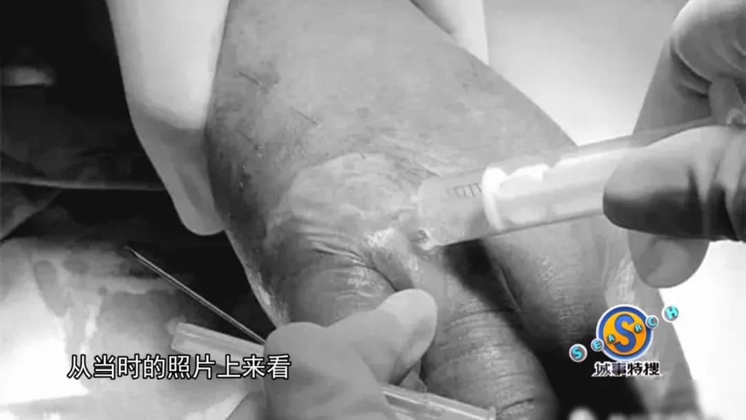 男子被钳子夹住致命部位,男子被咬一口全身器官衰竭