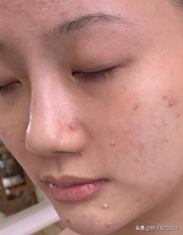 洗脸皂可以祛痘痘吗,用香皂洗脸会长痘痘吗