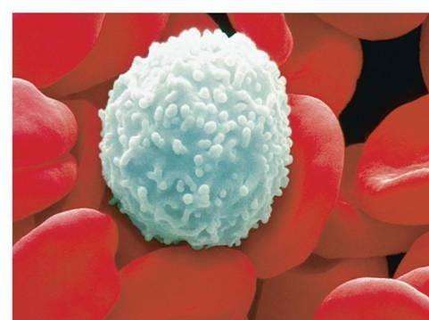 急性单核细胞白血病m5中医治疗,急性粒细胞白血病m5b型治疗方案