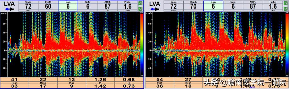 tcd发泡试验动图,发泡试验在南昌哪几家医院能做