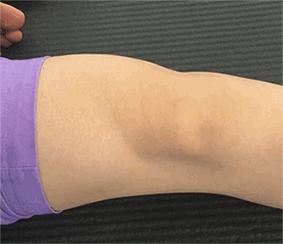 磁共振图片讲解半月板损伤的程度,磁共振半月板损伤严重