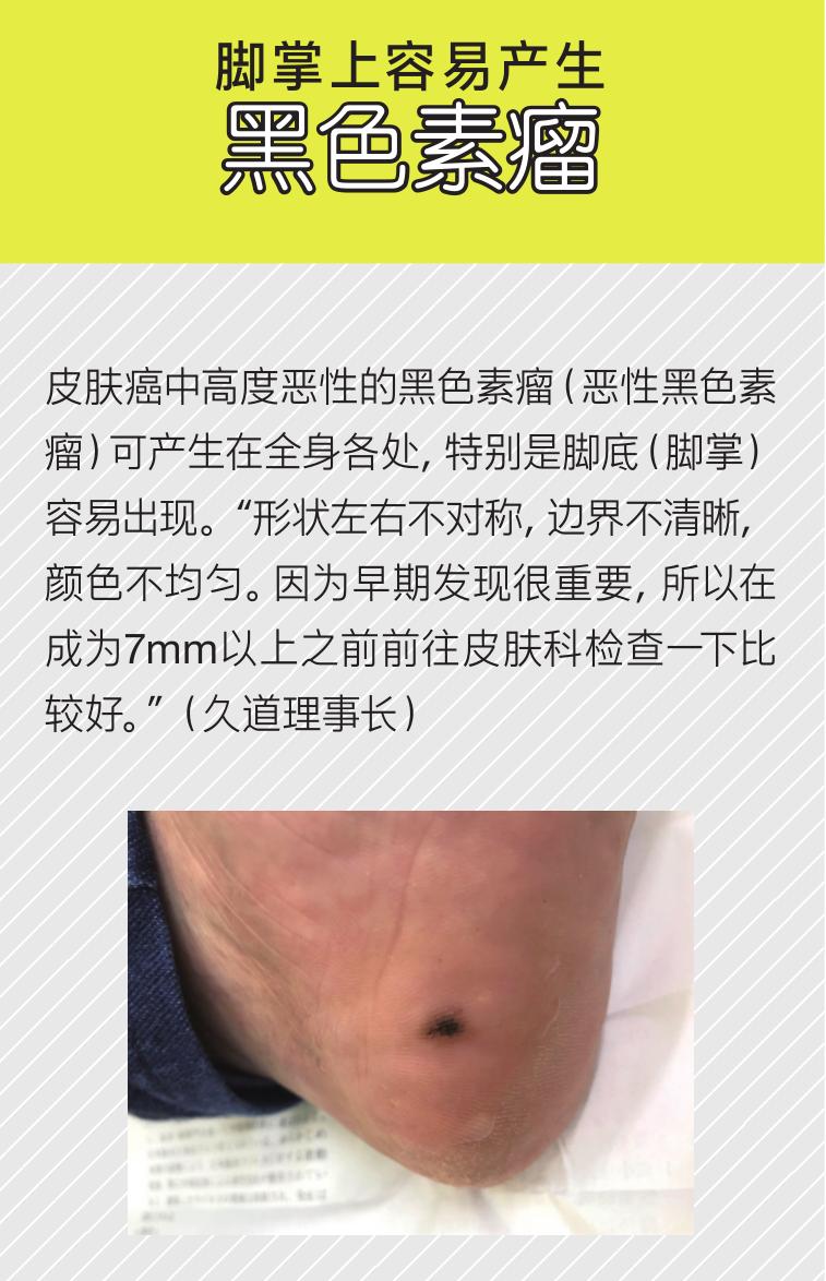 硬邦邦的老茧，会痛的鸡眼，日本皮肤科专家教你矫正足部恶习