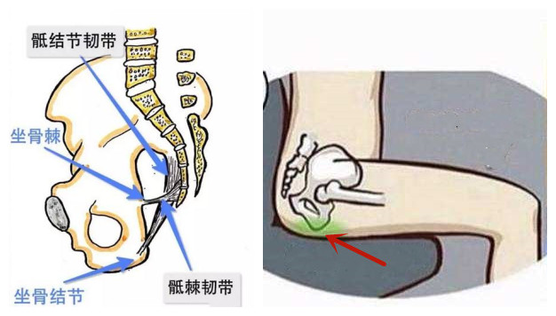臀部感觉有根筋痛,臀部有一个点酸疼怎么回事