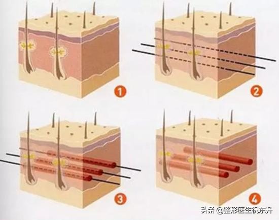 线雕只做一次会有后遗症吗,线雕只提升外轮廓吗