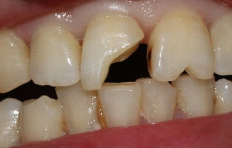 爱美者的100个困惑,牙齿缺失不想种植怎么办
