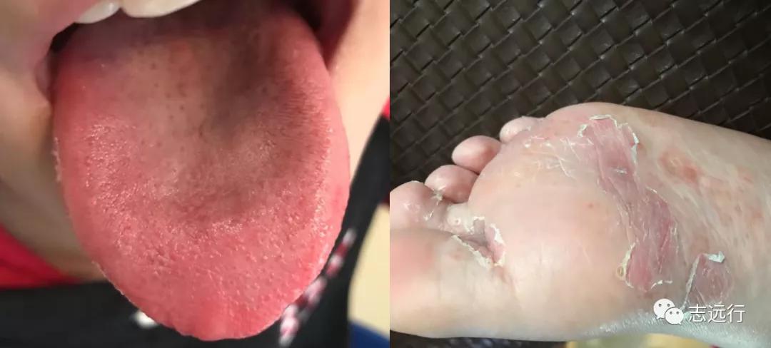 张景明治疗手足癣的中药方,手足癣单方大全