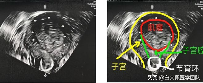 腹腔镜妇科解剖教学视频教程,白文佩医学团队
