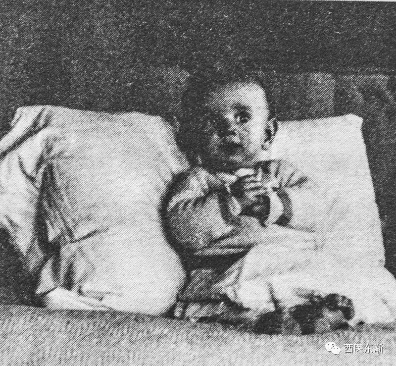 出现黑热病怎么办,得了黑热病传播途径