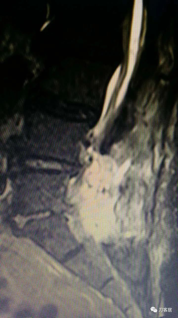 腰椎手术切掉棘突,腰突微创后出血肿