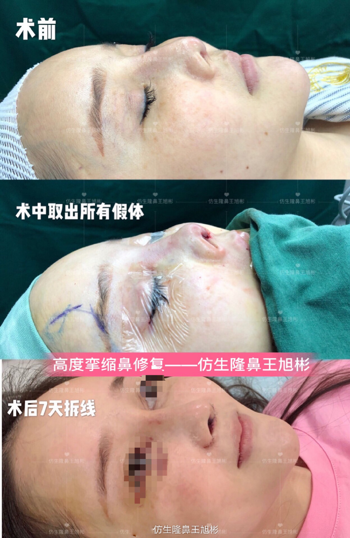 骨粉注射隆鼻皮肤变薄怎么办,线雕隆鼻会引起鼻挛缩吗