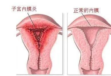 子宫内膜炎治疗费用,子宫内膜炎治疗一个疗程多少钱