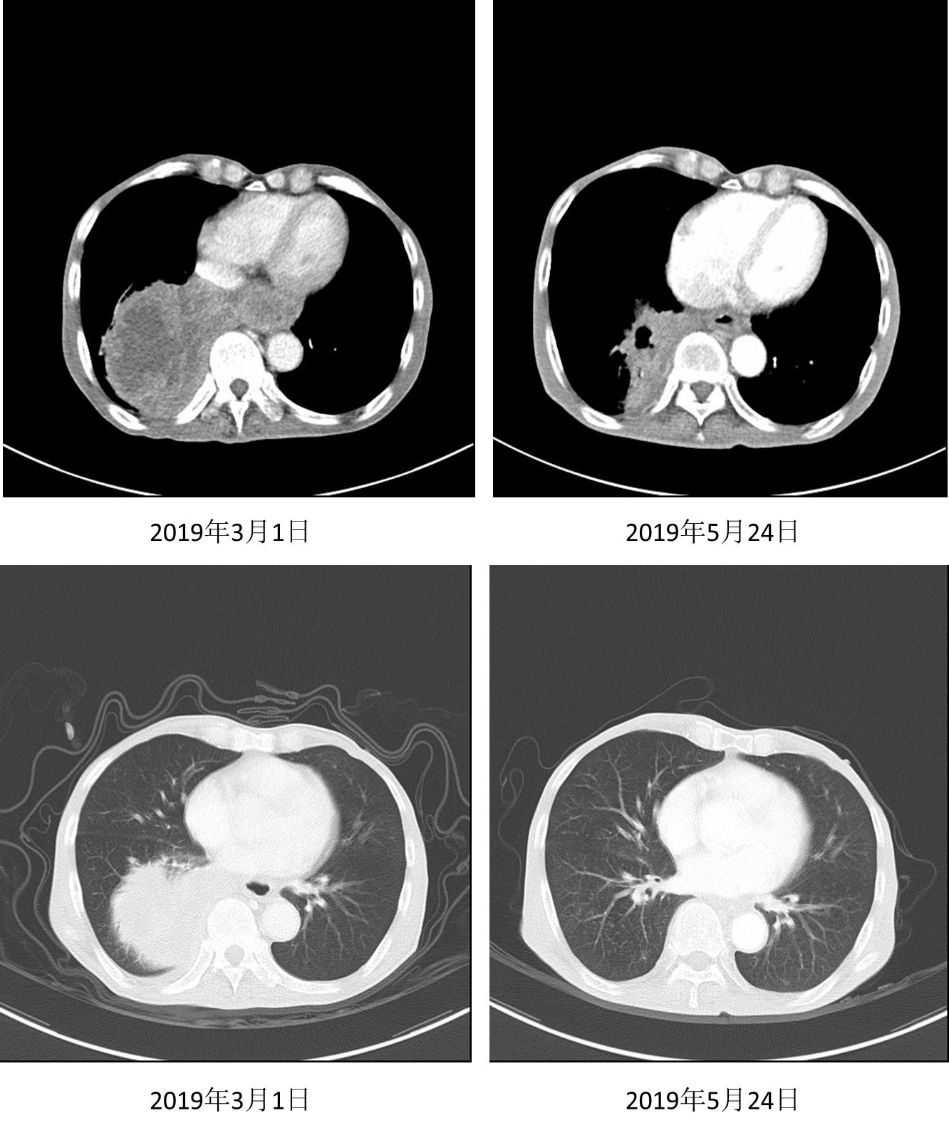 信迪利单抗治疗肺鳞癌效果,信迪利单抗治疗肺鳞癌晚期