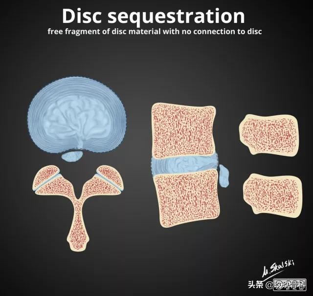 图解腰椎间盘突出,椎间盘髓核膨出图