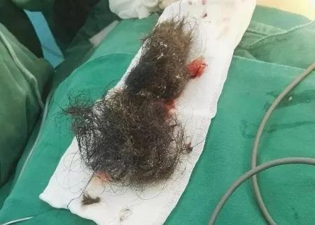 小女孩肚子里长畸胎瘤的原因,14岁女孩长出胎瘤