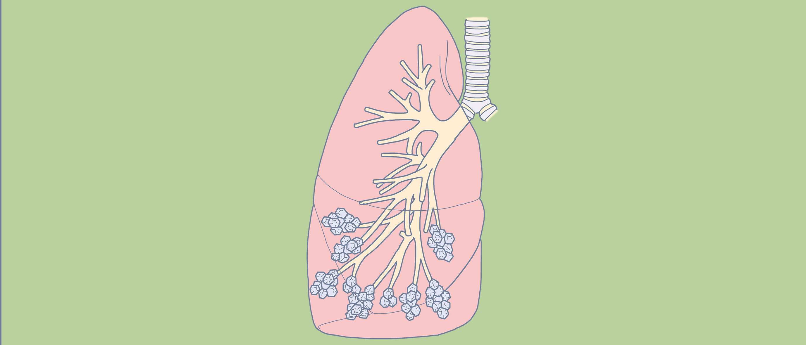 肺癌多大的概率会误诊,死亡率仅次于癌症的病