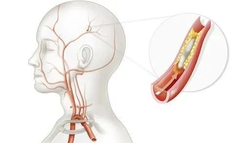 老年人吃阿司匹林应多少量,老年人吃阿司匹林好不好