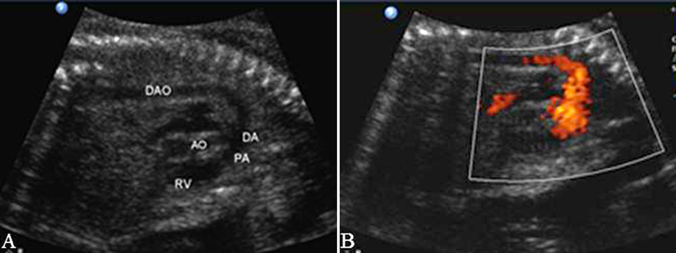 做普通的彩超能不能看到胎儿心脏,做彩超能知道胎儿准确多少周吗