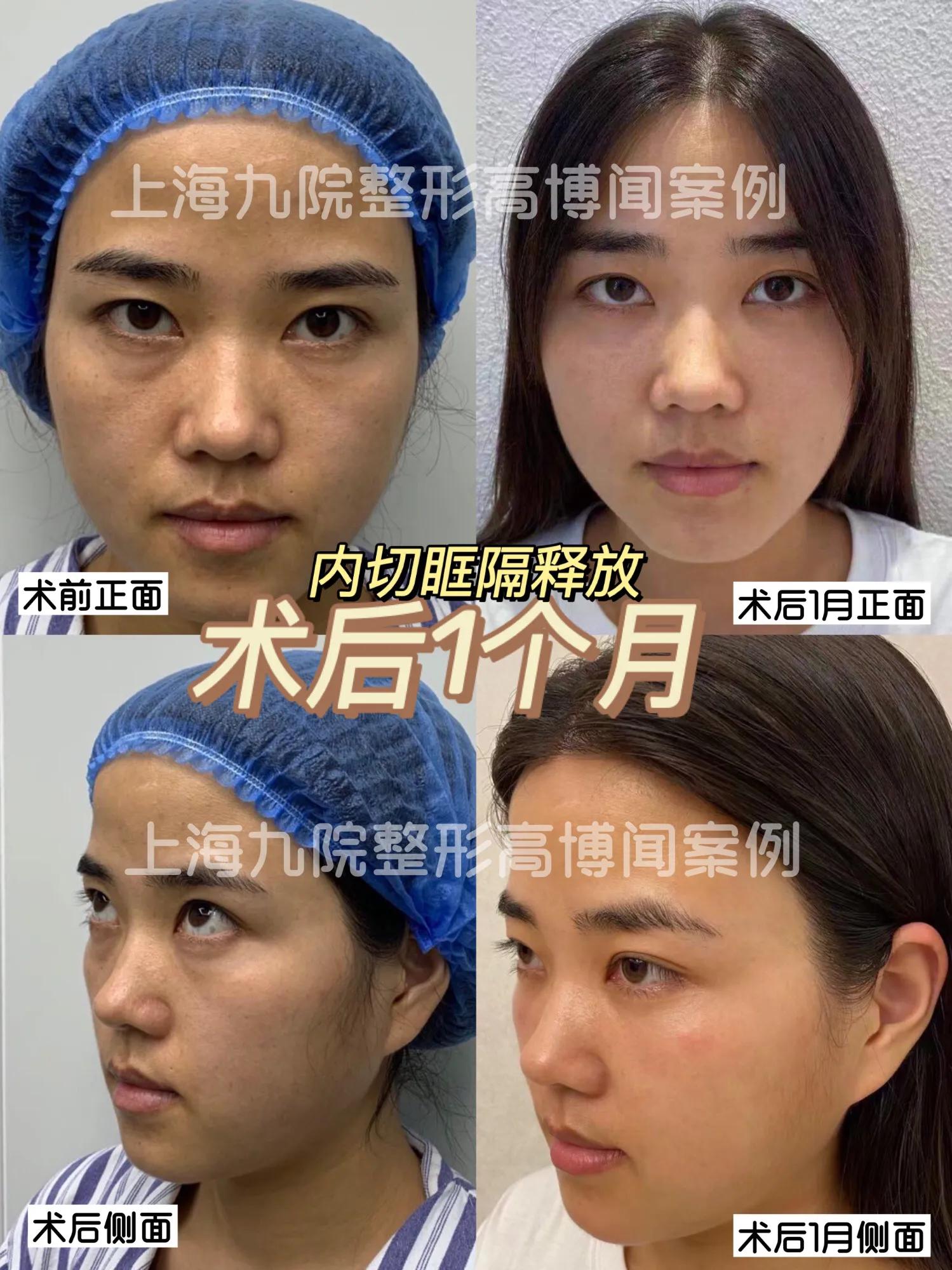 祛眼袋加眶隔释放要多久才恢复,眶隔释放眼袋术没做好怎么修复