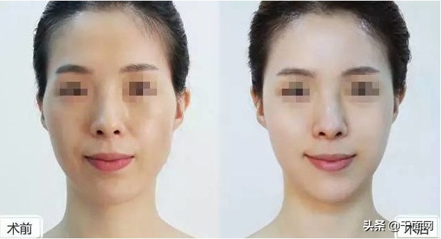 40多岁太阳穴凹陷填充,太阳穴凹陷填充分享