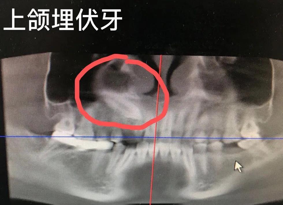 孕妇有牙病可以治吗,备孕牙齿上药需要注意啥