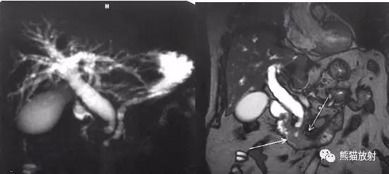 磁共振泌尿系水成像检查注意事项,磁共振影像基础知识讲解