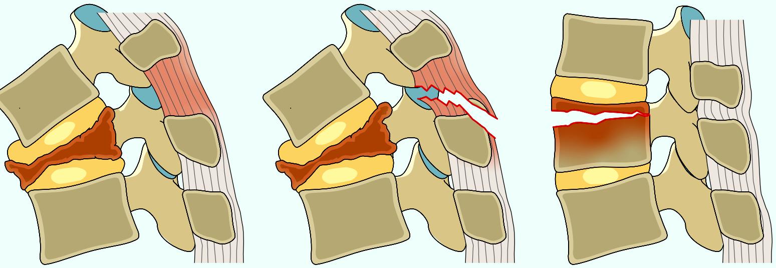 骨质疏松椎体压缩性骨折治疗指南,德国骨科骨质疏松骨折