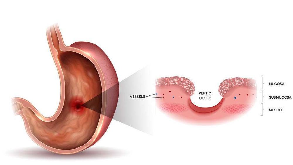 间充质干细胞注射抗衰老作用,间充质干细胞局部注射治疗肾损伤