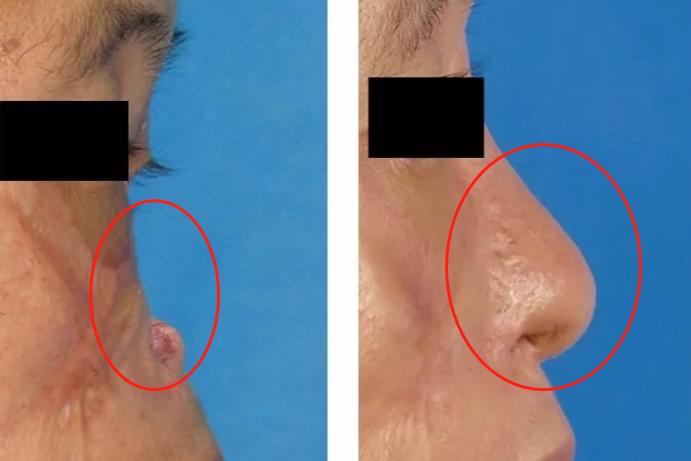 余文林鼻修复选择哪种材料更靠谱,余文林耳朵修复过程