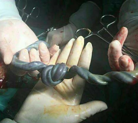 脐带绕颈一圈正常吗,孕期脐带绕颈是怎么回事