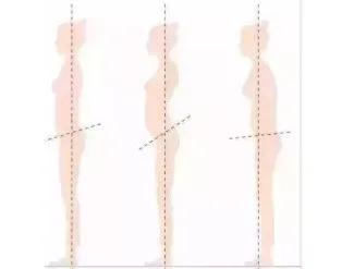 腰痛为什么会传到臀部,你为什么会经常腰痛