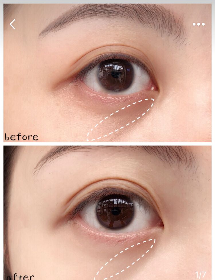 陆毅贝儿眼膜,陆毅用的眼膜