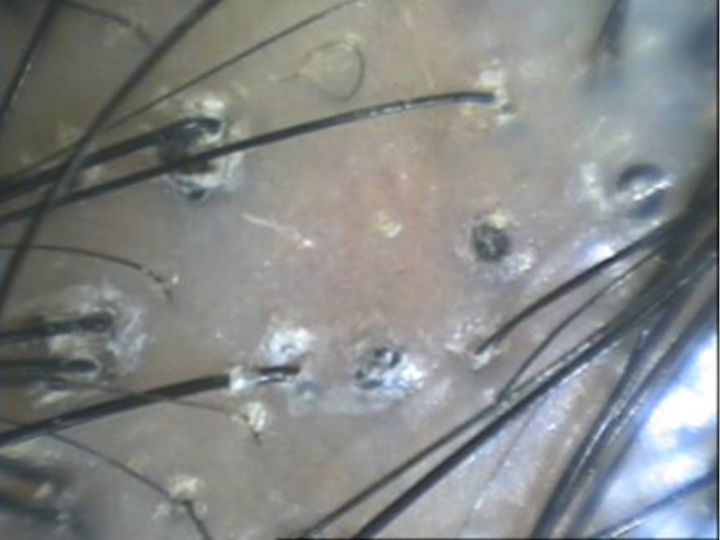 12岁女孩头皮屑多痒怎么回事,11岁女孩头皮屑很严重怎么治疗