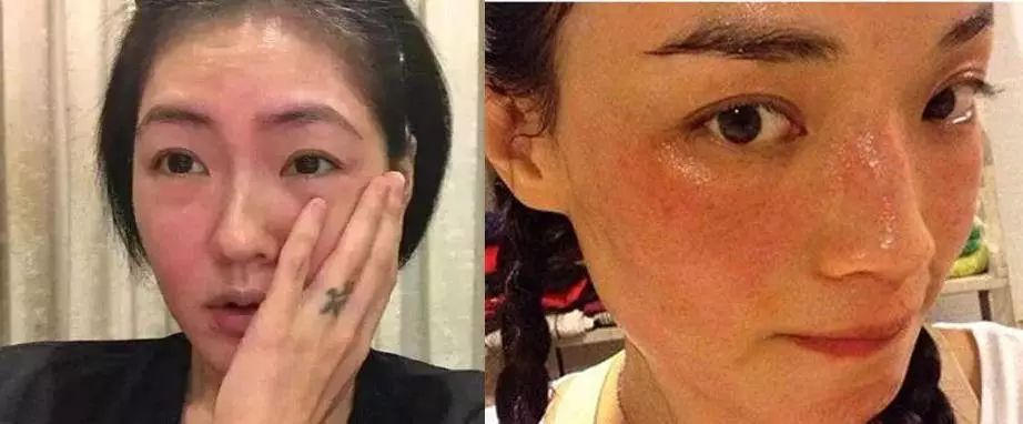 脱发算啥!90后已经开始长“老年斑”了,有人还为此花了10多万!