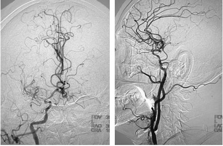颈动脉狭窄介入治疗的后遗症,颈动脉闭塞介入手术是局麻吗
