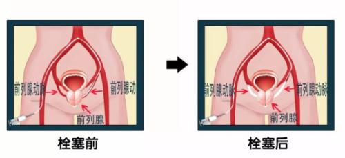 老人前列腺增生夜尿频多咋办,75岁老人前列腺增生手术利弊