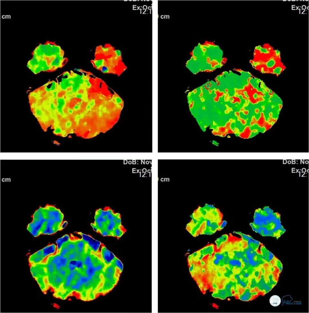 椎动脉狭窄介入手术病例汇报,基底动脉狭窄70%的介入治疗