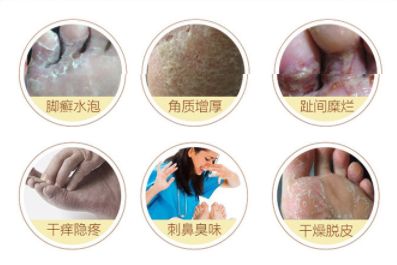 脚气脚臭难去除教你一招可以试试,脚臭脚气脚痒脱皮干裂一招根除