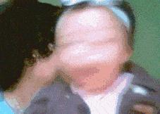 胳膊上的小圆疤是什么,手臂的疤是怎么形成的