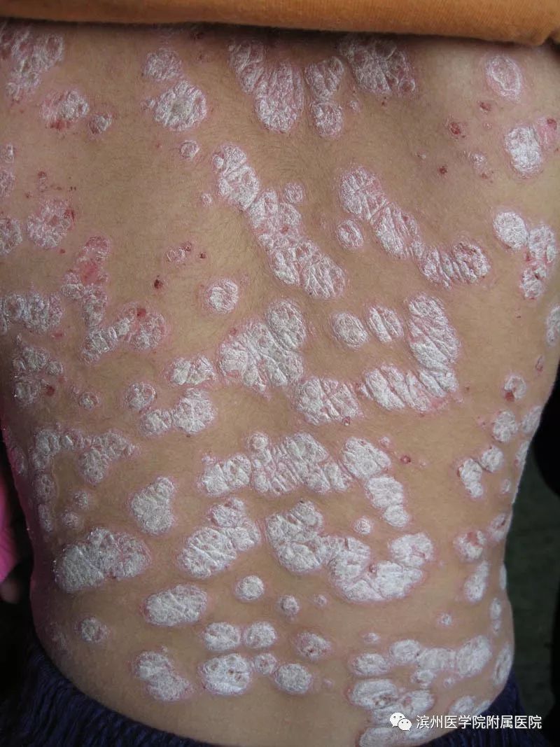 皮肤科专家真菌感染牛皮癣,还在受皮肤病困扰吗