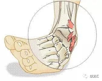 脚踝扭伤很痛怎么医,脚踝内侧筋痛扭伤详细康复训练