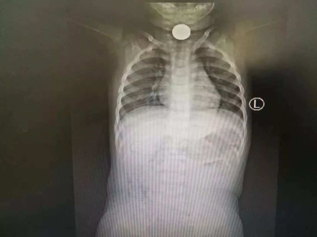 震惊！河北一岁女童鼻腔里竟取出一只蜗牛！