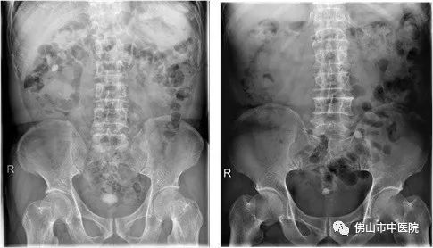 小心膀胱结石,膀胱结石的初期症状是什么